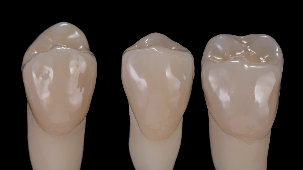 Fig. 13: The crowns after the characterisation firing on tooth-coloured dies.